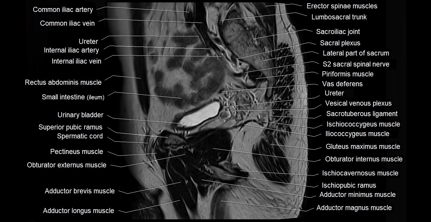 male pelvis sagittal cross sectional anatomy 3T mri image 32.webp